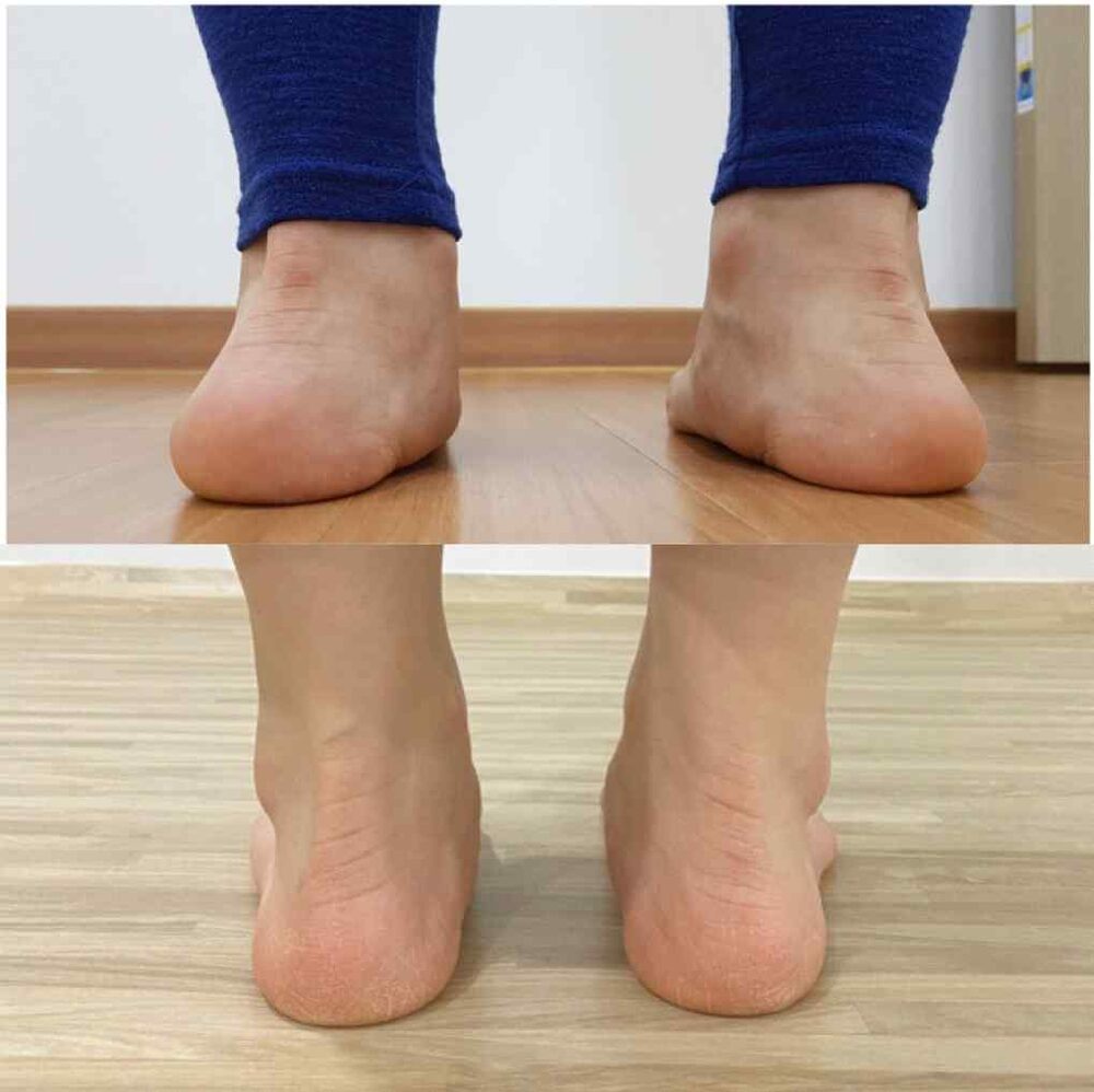 류다감 평발에서 아치 형성 전후