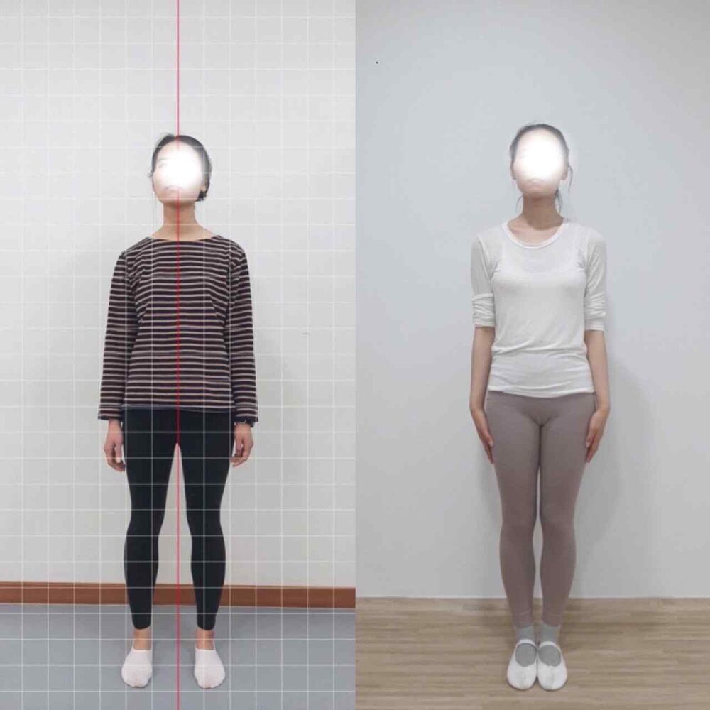 턱관절 통증과 온몸의 미세떨림 — 직장을 관둘 만큼 허약했던 몸의 회복 — 전신 전후(앞)